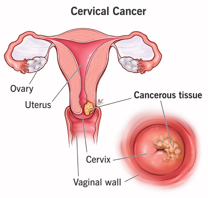 Unveiling the Battle Against Cervical Cancer ps