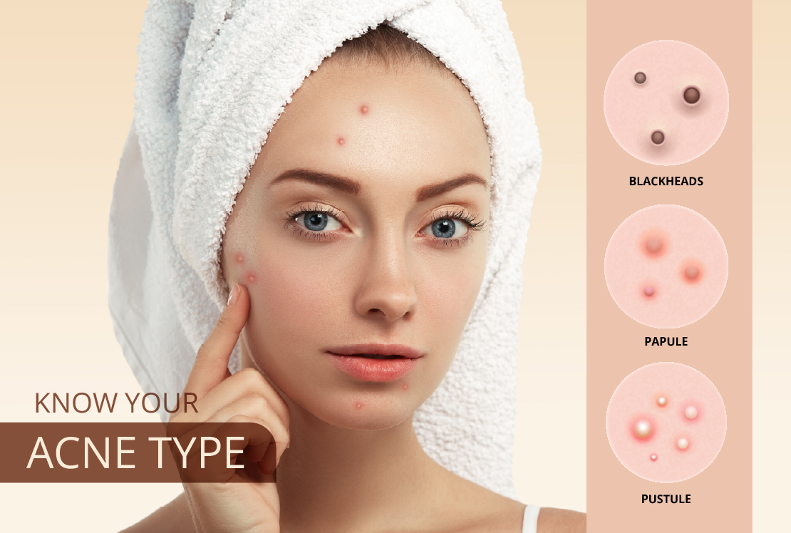 Know everything about Acne, Types of Acne, and treatment methods