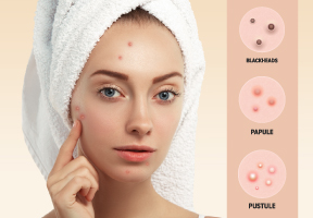 Understanding the Types of Acne and Treatment Options