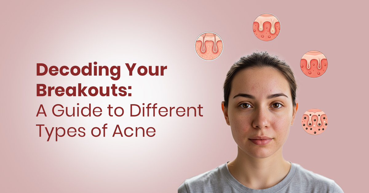 Decoding Breakouts: A Guide to Different Types of Acne