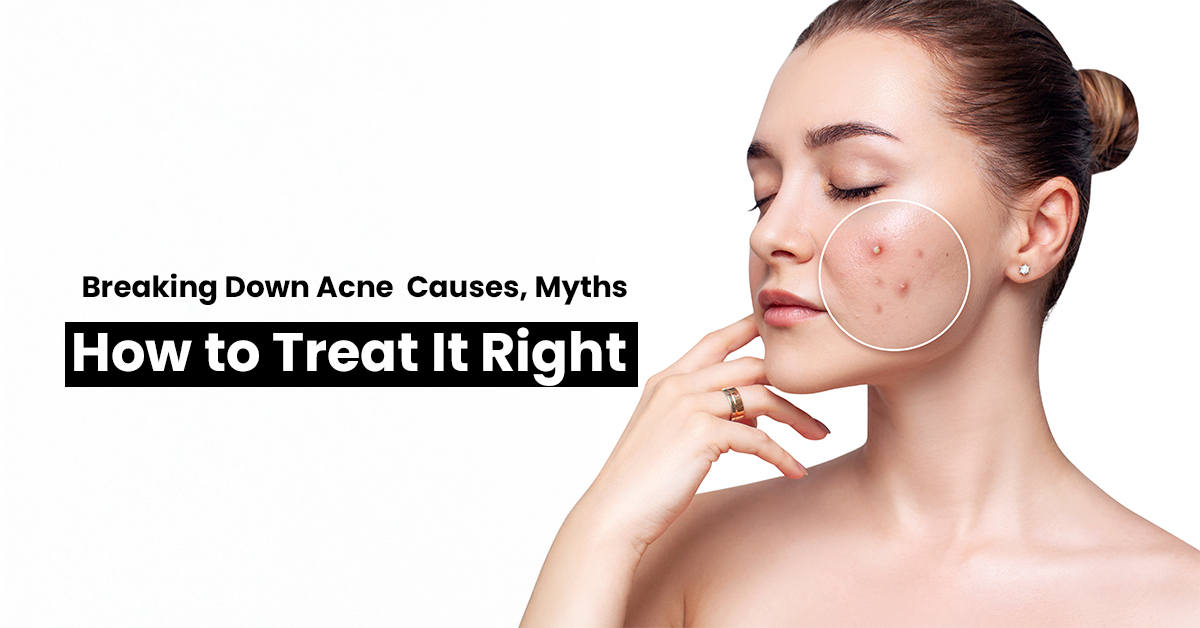 Breaking Down Acne: Causes, Myths & Effective Treatments